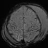 12A1 H-I, neonatal, (Case 12) SWI Images 3 - Copy