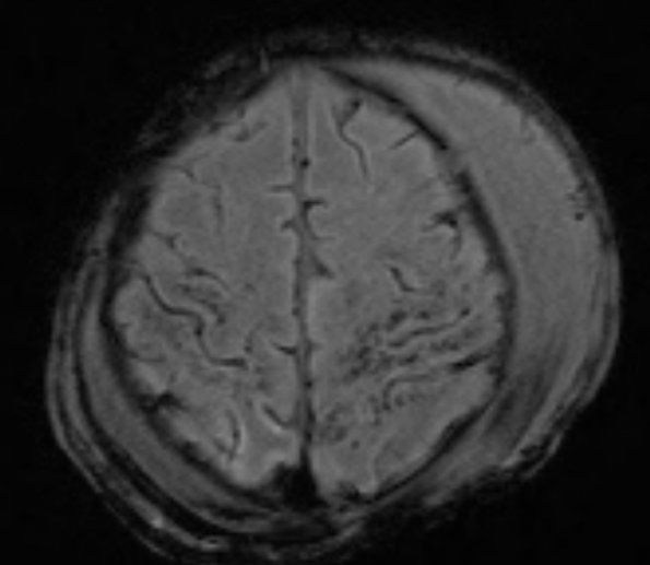 12A1 H-I, neonatal, (Case 12) SWI Images 3 - Copy