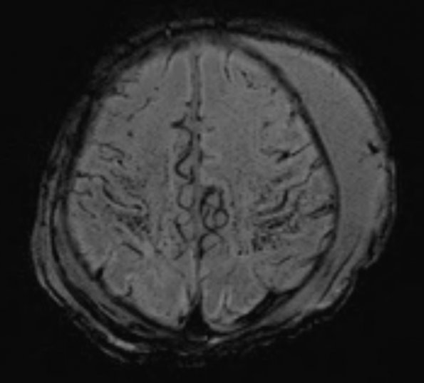 12A2 H-I, neonatal, (Case 12) SWI 8 - Copy