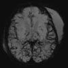 12A3 H-I, neonatal, (Case 12) SWI 1 - Copy