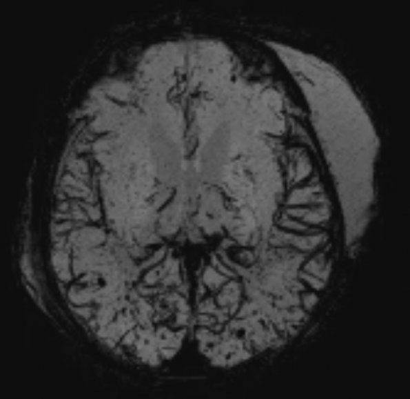 12A3 H-I, neonatal, (Case 12) SWI 1 - Copy