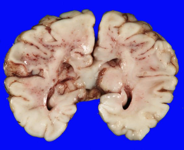 12B H-I, neonatal, (Case 12) Gross 7 - Copy