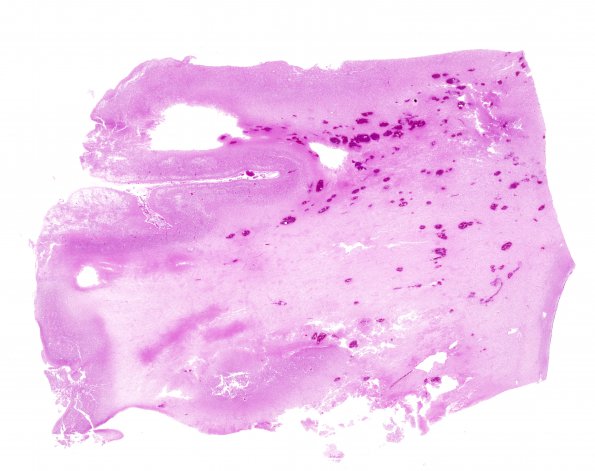 12C1 H-I, neonatal, (Case 12) N13 H&E WM