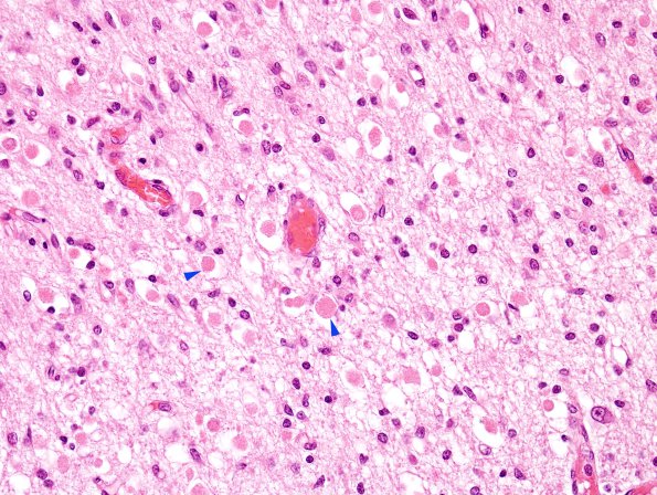 12C3 H-I, neonatal, (Case 12) N3 LGN H&E 1 copy