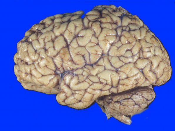 13A1 H-I, neonatal (31wk), died at 22yo (Case 13) 3