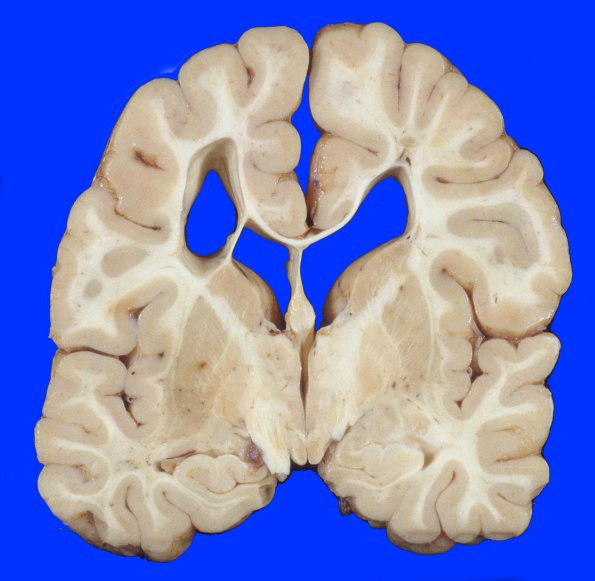 13A2 H-I, neonatal (31wk), died at 22yo (Case 13) 2