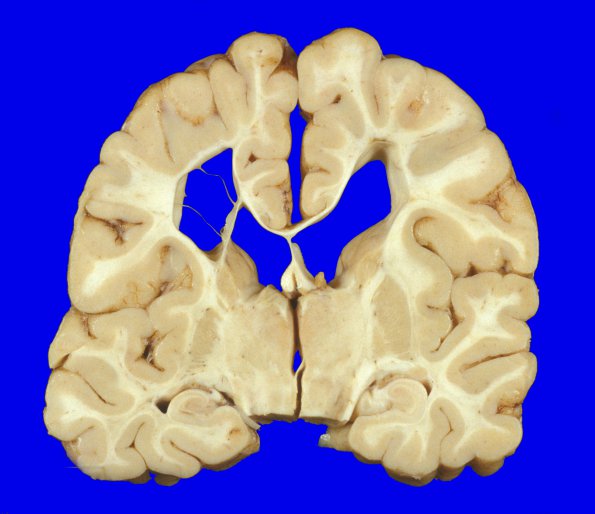 13A3 H-I, neonatal (31wk), died at 22yo (Case 13) 1 (2)