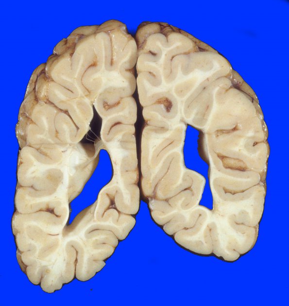 13A4 H-I, neonatal (31wk), died at 22yo (Case 13) 1