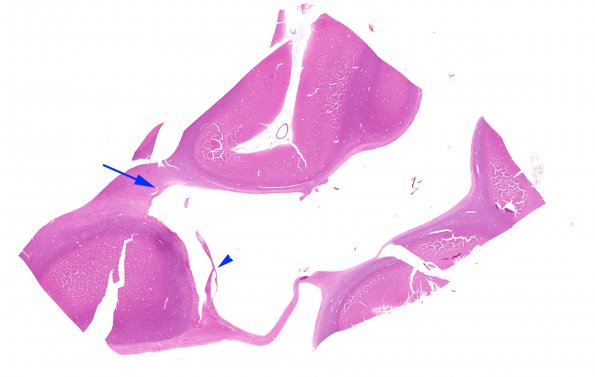 13B1 H-I, neonatal (31wk), died at 22yo (Case 13) WM