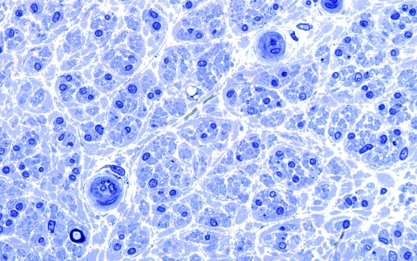 13B2 (Case 13) Plastic 100X 3