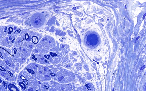 14A1 (Case 14) Plastic 100X 1