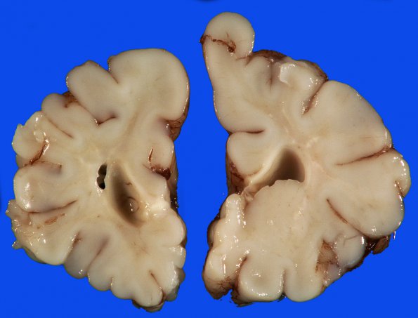 14A2 Hypoxia-Ischemia, neonatal (Case 14) 2