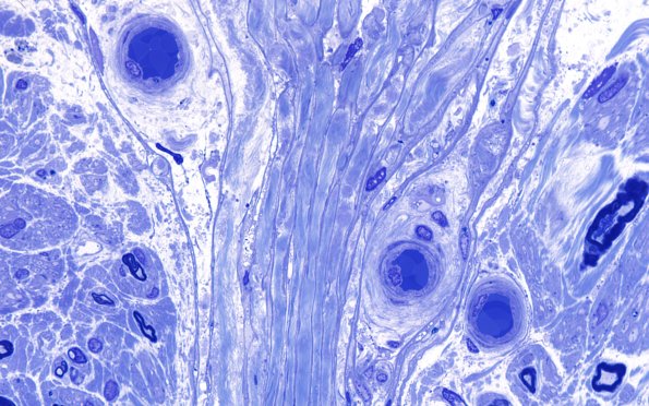 14A2 (Case 14) Plastic 100X 2