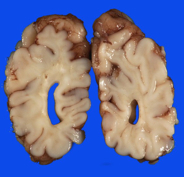 14A3 Hypoxia-Ischemia, neonatal (Case 14) 8