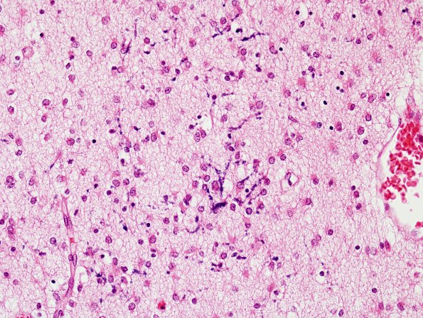 14B1 Hypoxia-Ischemia, neonatal (Case 14) Periventricular WM H&E 1.jpg