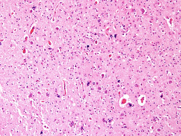 14B2 Hypoxia-Ischemia, neonatal (Case 14) Thal 4.jpg