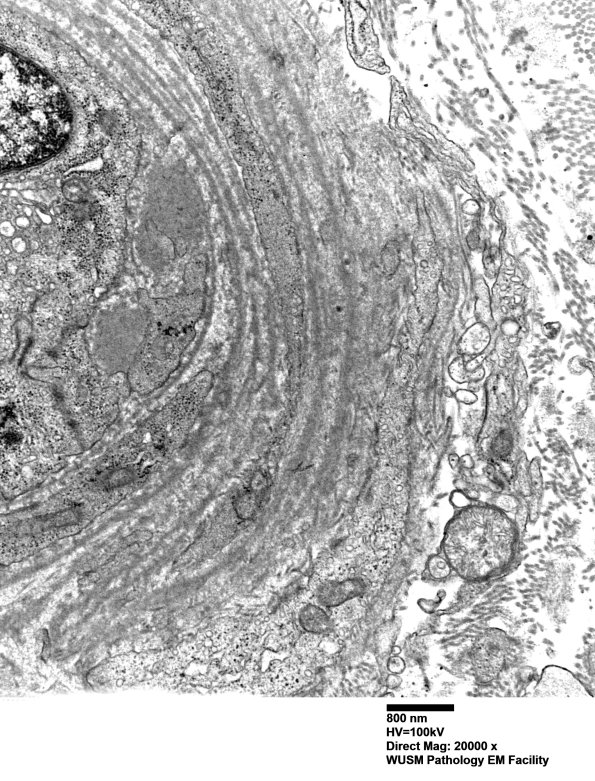 14B3B (Case 14) EM018 - Copy