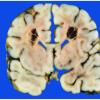 Hypoxia-Ischemia, fetal-neonatal