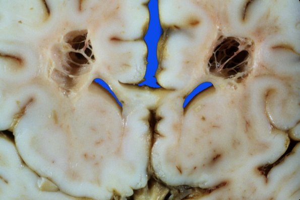 15A2 Infarct, neonatal perivascular (Case 15) 1