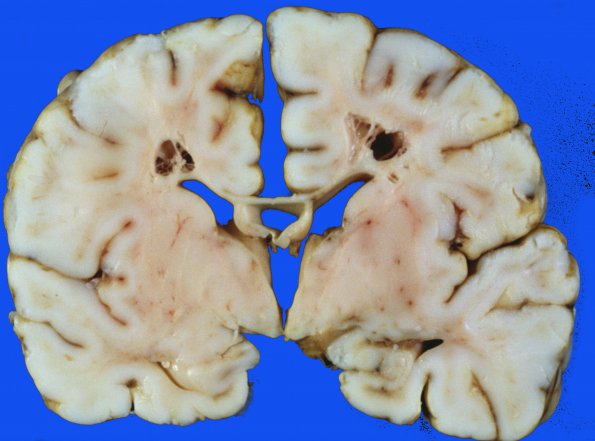 15A3 Infarct, neonatal perivascular (Case 15) 7