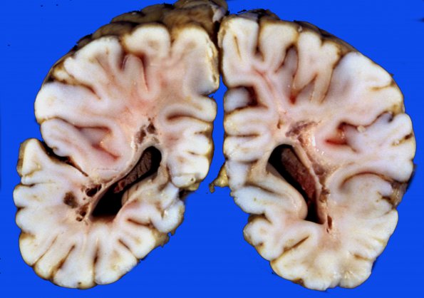 15A4 Infarct, neonatal perivascular (Case 15) 8