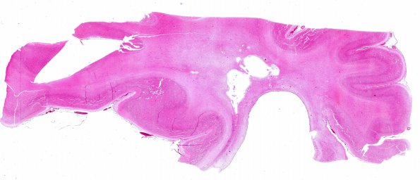 15B1 Infarct, neonatal perivascular (Case 15) H&E D WM