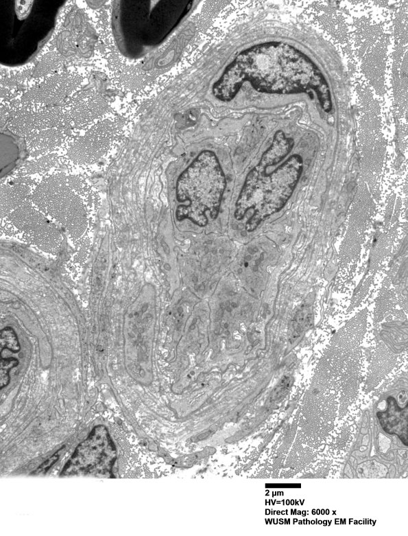 15B1 (Case 15) HIEM EM 002 - Copy