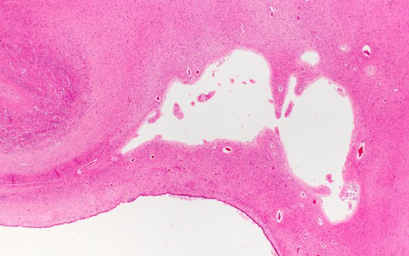 15B2 Infarct, neonatal perivascular (Case 15) H&E D 10X