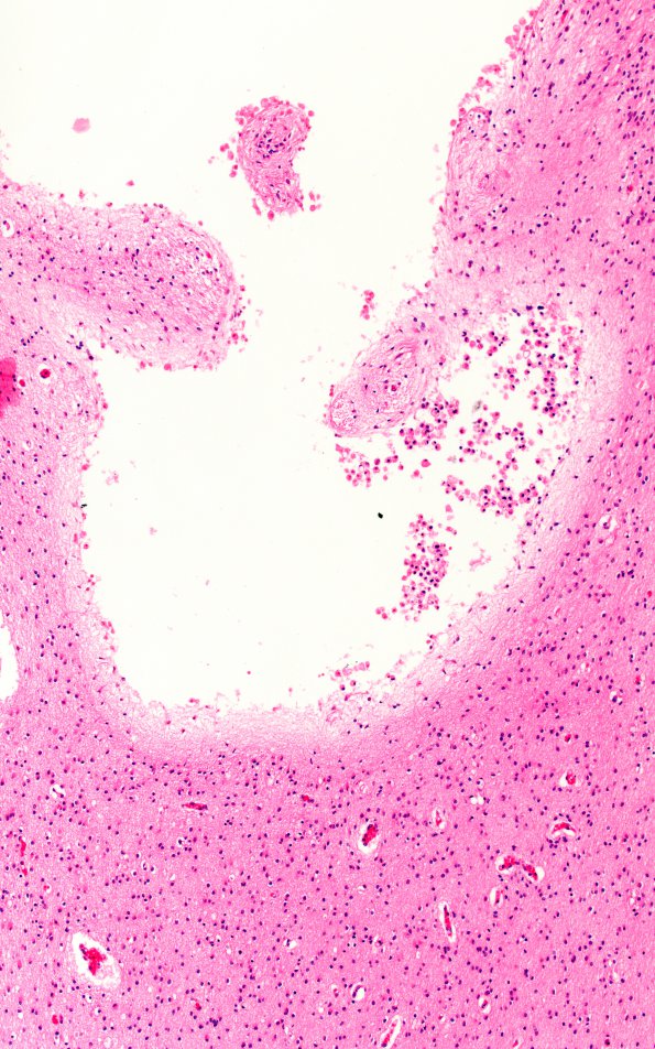 15B3 Infarct, neonatal perivascular (Case 15) H&E D 10X