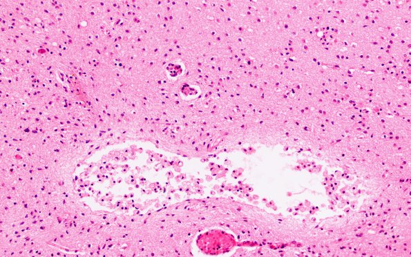 15B4 Infarct, neonatal perivascular (Case 15) H&E D 20X