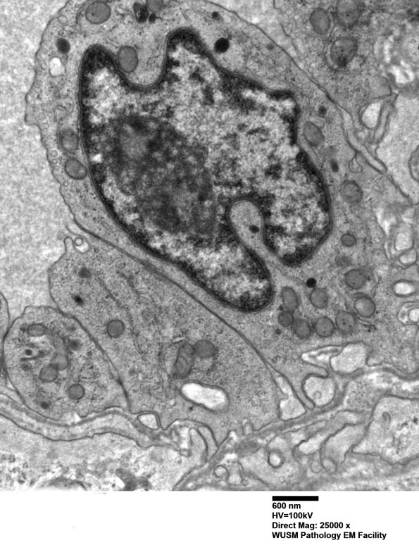 15B4 (Case 15) HIEM EM 007 - Copy