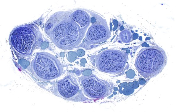 16A1 (Case 16) HIEM Plastic 4X