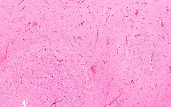 16B1 Hypoxia-Isschemia neonatal (A36263) H&E N13 2X