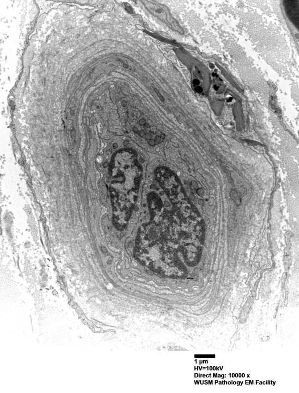 16B5 (Case 16) HIEM EM028 - Copy
