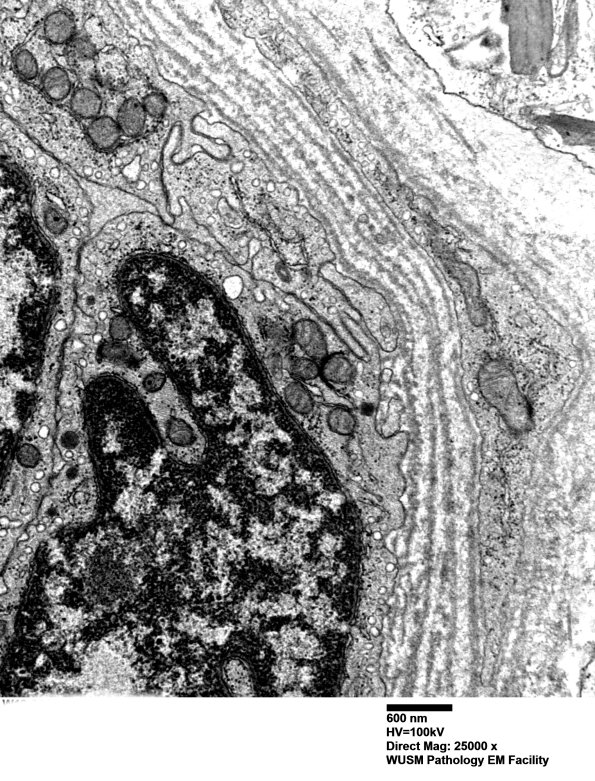 16B6 (Case 16) HIEM EM029 - Copy