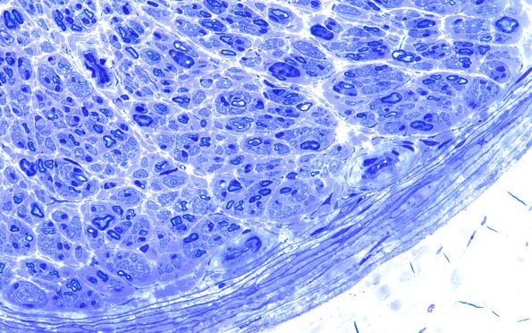 17A (Case 17) HIEM 60X 1