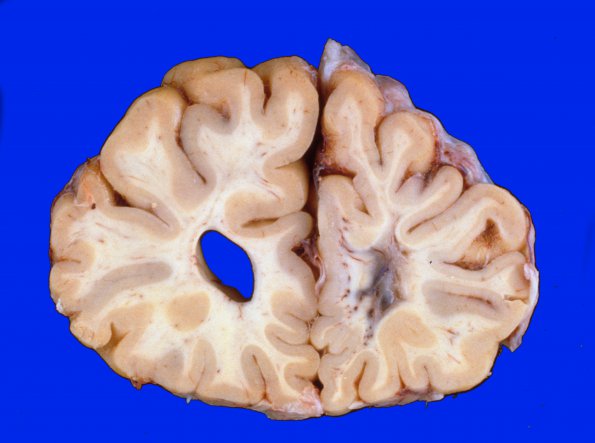 17A1 Hypoxia-Ischemia, Neonatal (WUMS)