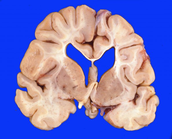 17A2 Hypoxia-Ischemia, Neonatal (WUMS) 2