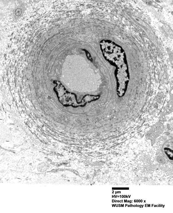 17B1 (Case 17) HIEM EM015 - Copy