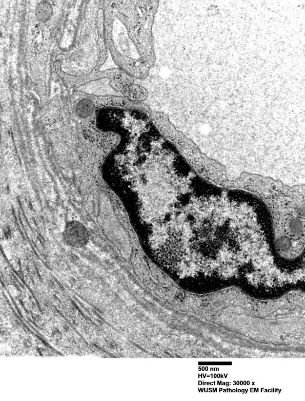 17B3 (Case 17) HIEM EM017 - Copy