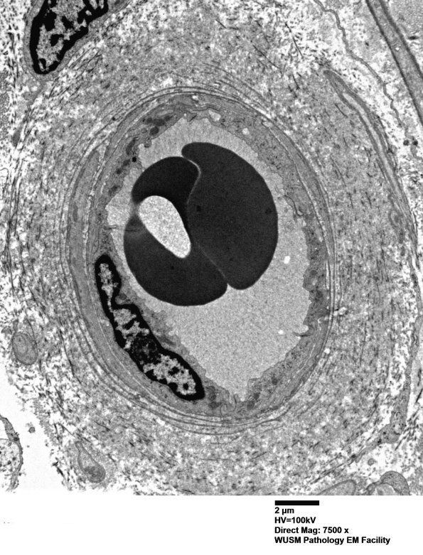 17B4 (Case 17) HIEM EM018 - Copy