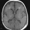 18A1 Hypoxia-Ischemia, neonatal, intrauterine (Case 18) T1 2 - Copy