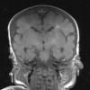 18A2 Hypoxia-Ischemia, neonatal, intrauterine (Case 18) T1 3 - Copy