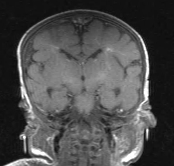 18A2 Hypoxia-Ischemia, neonatal, intrauterine (Case 18) T1 3 - Copy