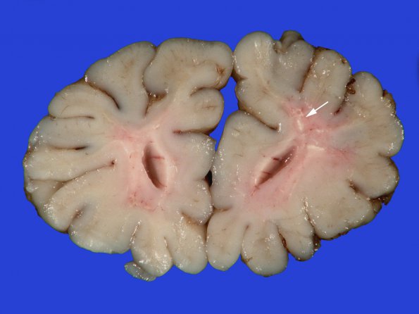 18B1 Hypoxia-Ischemia, neonatal, intrauterine (Case 18) Gross_1 copy