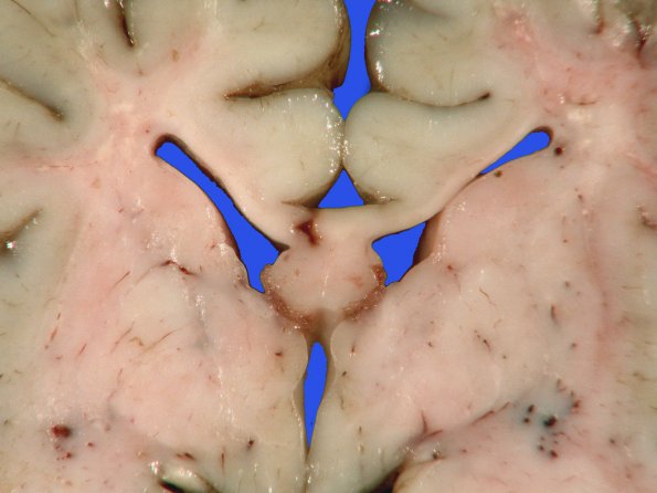 18B2 Hypoxia-Ischemia, neonatal, intrauterine (Case 18) Gross_4