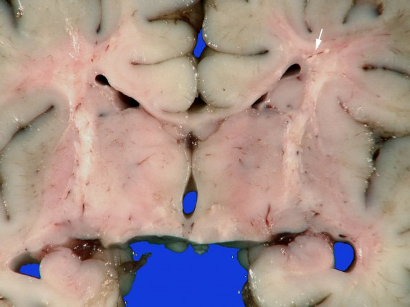 18B3 Hypoxia-Ischemia, neonatal, intrauterine (Case 18) Gross_6 copy