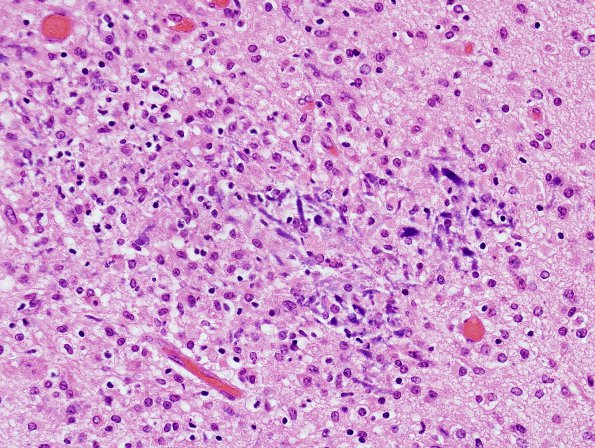 18C2 Hypoxia-Ischemia, neonatal, intrauterine (Case 18) H&E N11 2