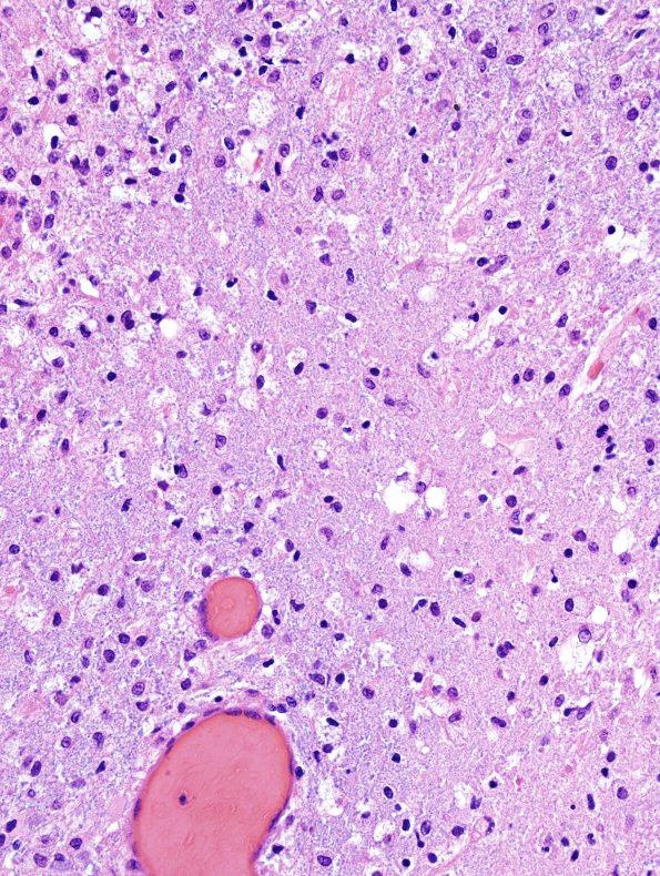 18C3 Hypoxia-Ischemia, neonatal, intrauterine (Case 18) H&E N11 5