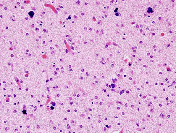 18C4 Hypoxia-Ischemia, neonatal, intrauterine (Case 18) H&E N11 1